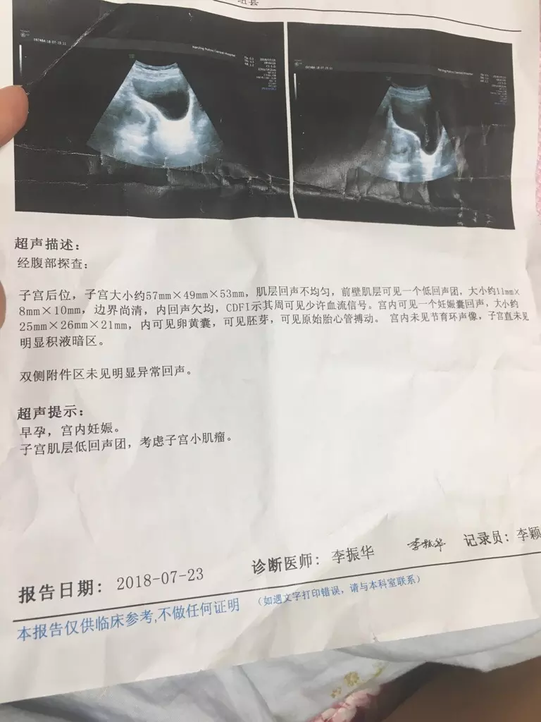 早孕看孕囊看男女准嗎：從孕囊看男女真的那麼准嗎？