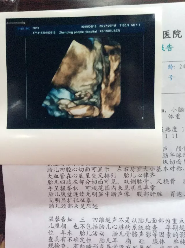 4、B超四維一看就是男孩:B超真的不準，照出來男孩，生出來是女孩！