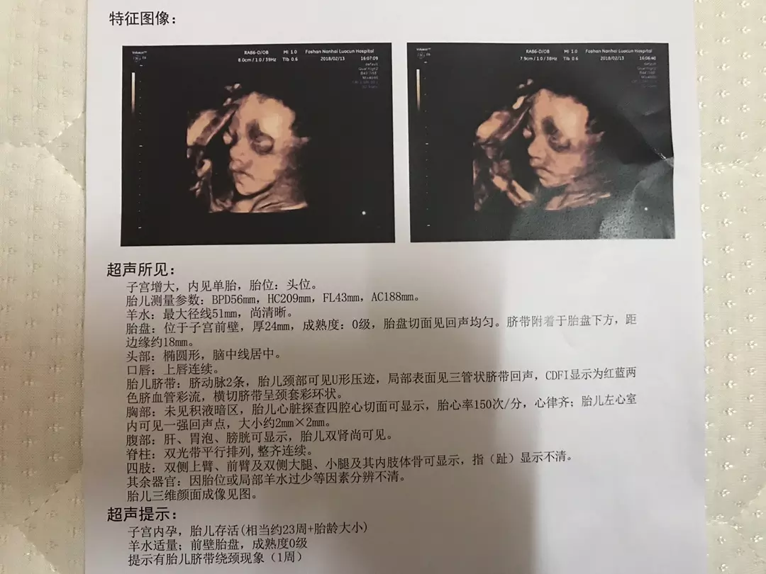 2、無創DNA檢測數據18高於13和21是還是女寶