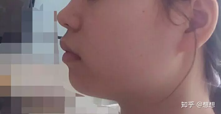 1、上嘴唇又厚又翹怎麼辦:嘴唇又大又厚還有點翹怎麼辦