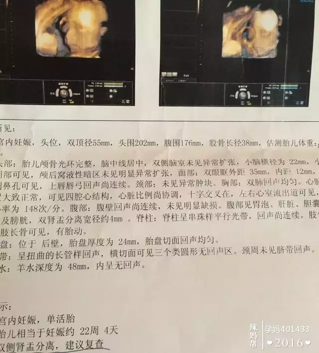四維雙無分離是男孩女孩：有沒有雙無分離生的寶媽？