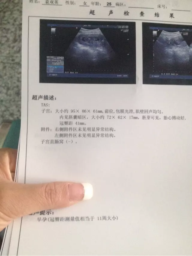 懷孕兩個月看男女妙招：兩個月怎麼判斷男女