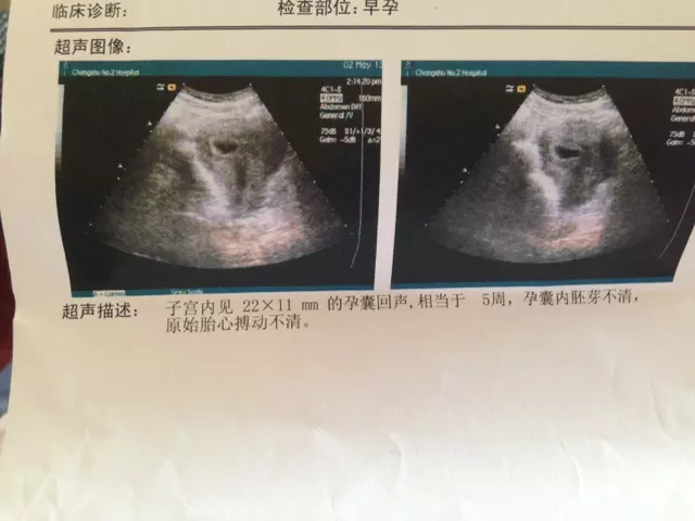 孕囊大小和性別有關嗎：胎囊3個數據看男女公式哪裡可以找到？