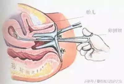 四個月胎兒人流下來圖：要是懷孕四個月人流，胎兒成型沒有