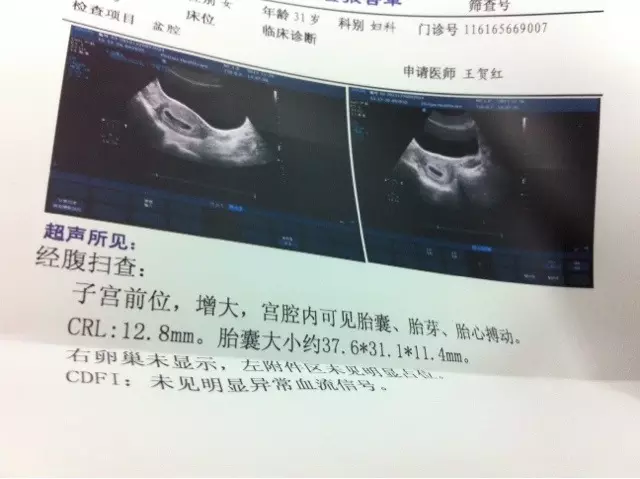 孕囊大小計算懷孕天數準確嗎：可以根據孕囊大小推算出時間嗎