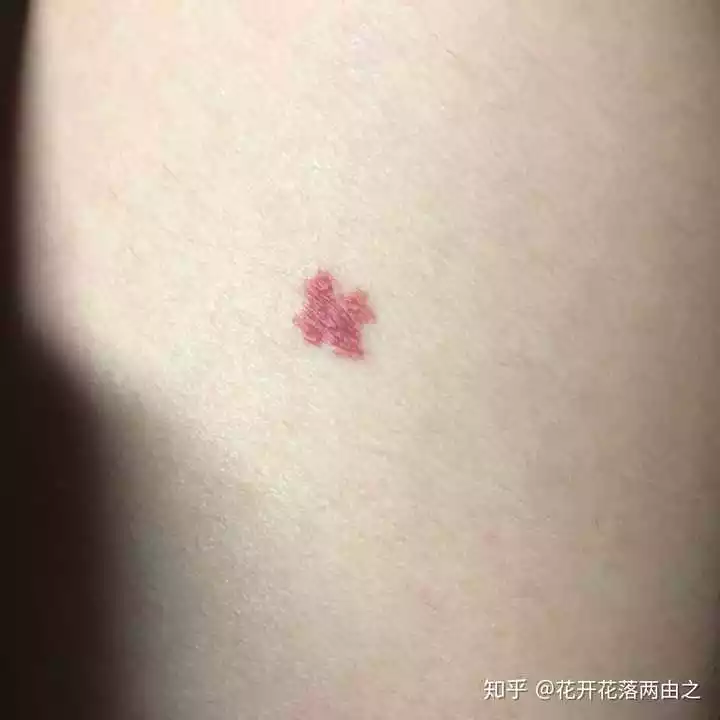 最有福氣的9處胎記長在哪裡：胎記圖片大全圖解?