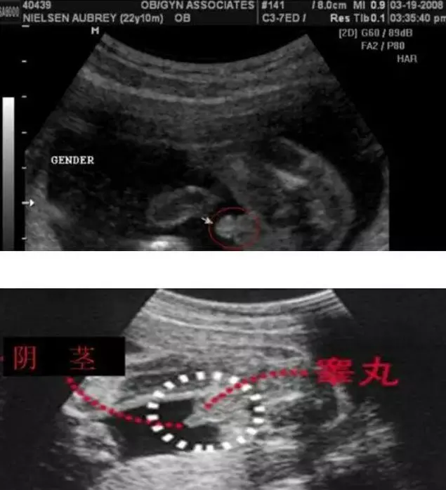 胎兒位置在右邊看男女：胎動經常出現在右邊跟男孩女孩有關係嗎，一般是什麼原因？