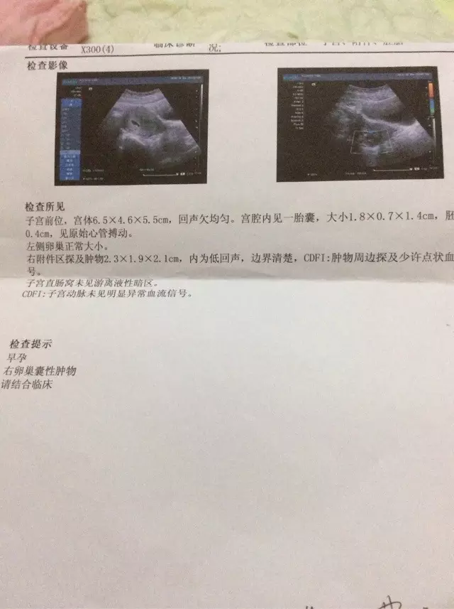 3、孕囊尺寸三個數據圖解看男孩:看孕囊數據大小能看出男女嗎
