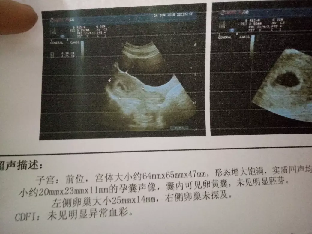 早期看孕囊數據男女真的准嗎：孕早期孕囊長圓通過B超數據真的可以看出男女嗎？