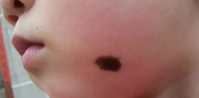 1、有胎記的孩子是什麼來的:有的寶寶出生身上會帶有胎記，這是從何而來呢？