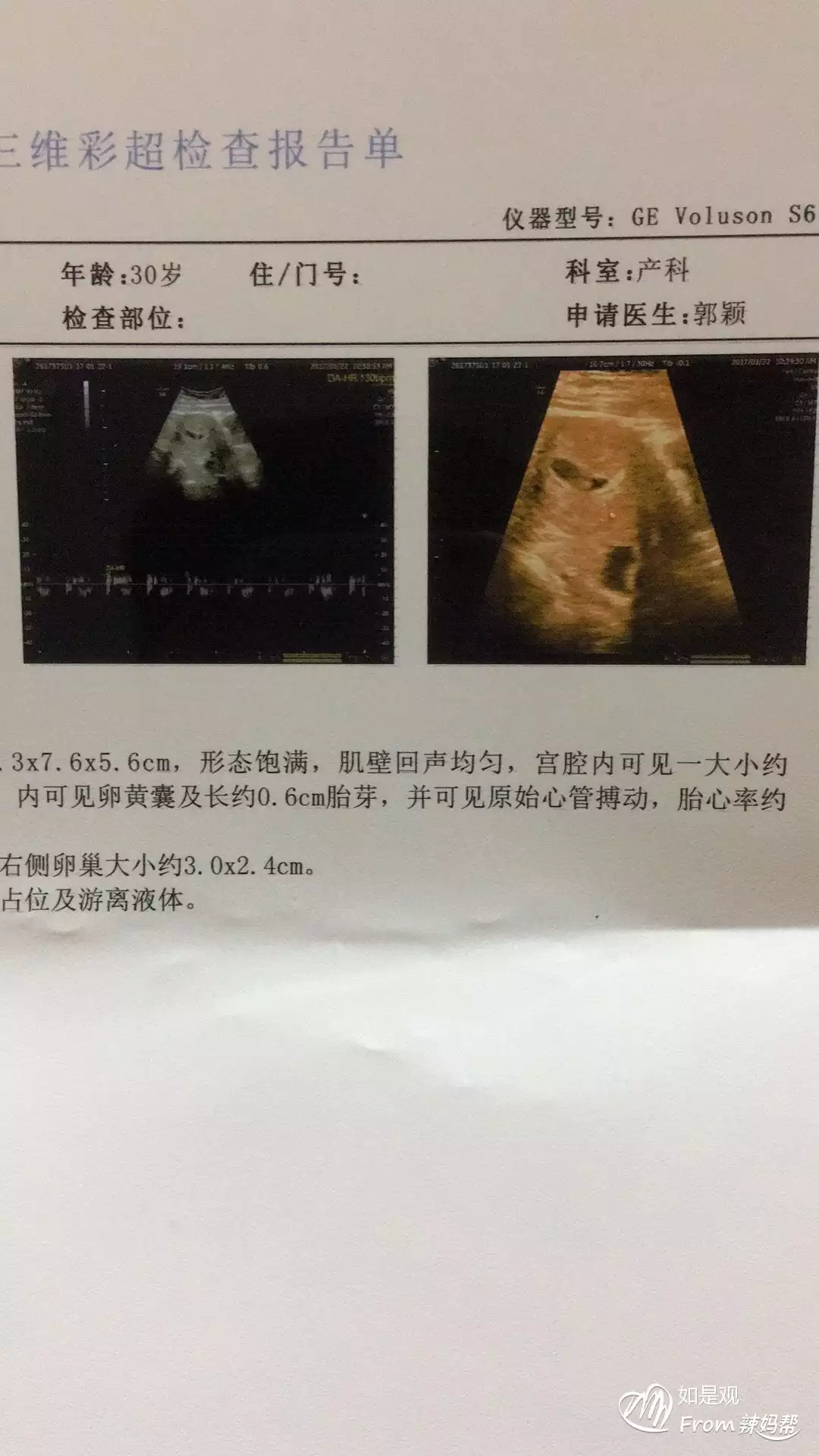 孕囊看男女幾周最準確：孕囊形狀看男女准嗎？？
