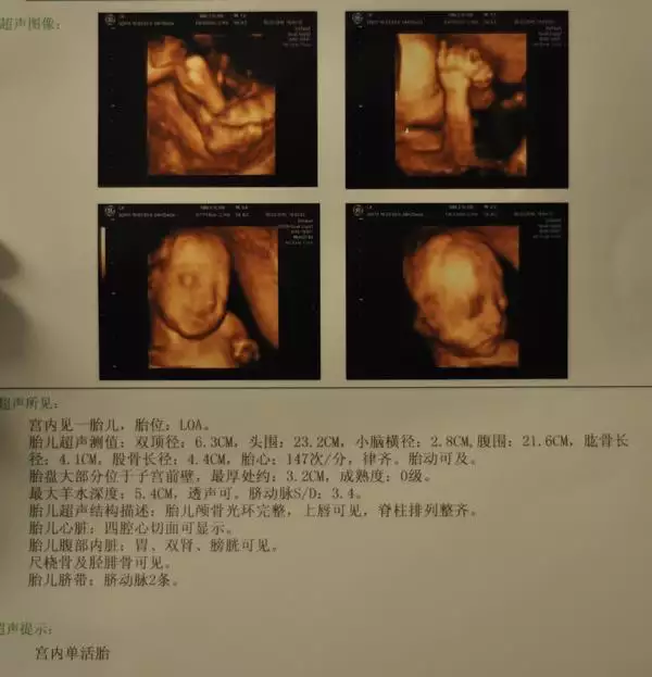 醫生在B超室會說哪些暗示胎兒性別的行話，究竟有多含蓄？