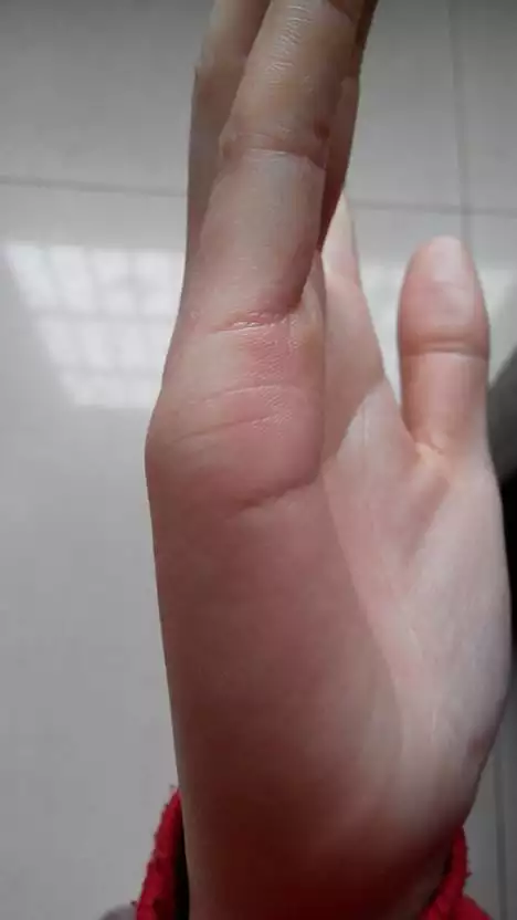 2、婚姻線斷了代表什麼:婚姻線斷開一點點什麼含義
