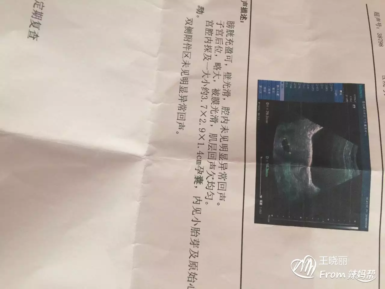 2、九個最准懷女孩徵兆:懷兒子的特徵最準的