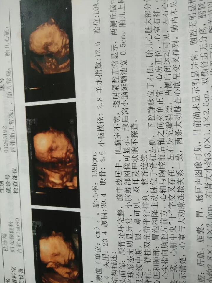 四維彩超怎麼分辨男孩女孩：四維彩超單怎麼看是男孩還是女孩？