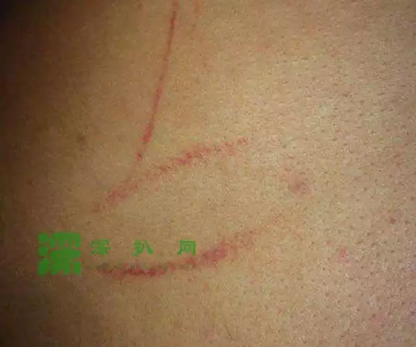 4、哪種抓痕屬於出軌:請協助看一下我老公身上的抓痕，是出軌了嗎？謝謝