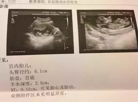3、平躺下看男女,很准喲:四個月去做b超檢查孩子是平躺着的，能辨認出男女吧