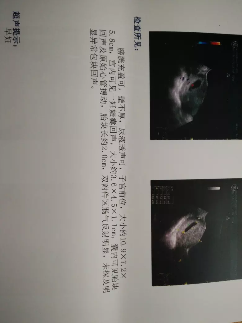 胎心在是男孩：胎心多是男孩還是女孩