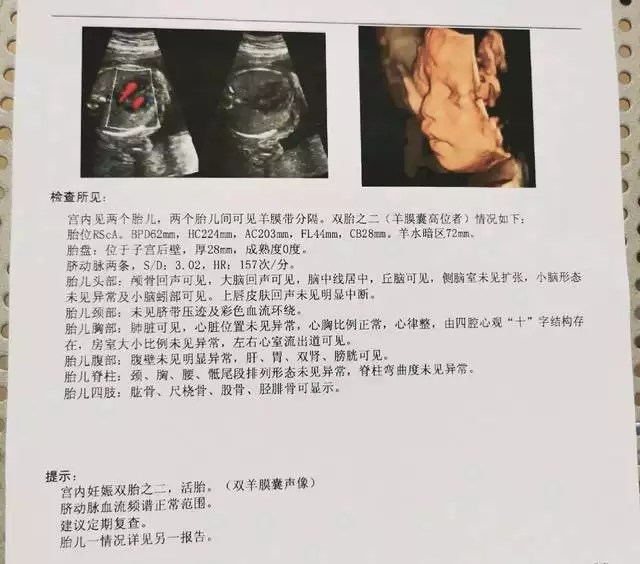 四維彩超怎麼分辨男孩女孩：四維彩超怎麼分男女