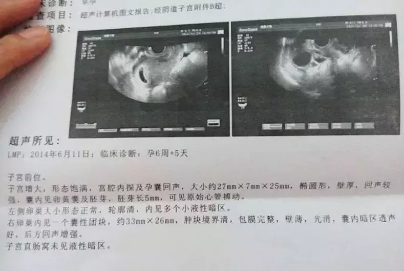 孕囊數據兩大一小是男孩：懷男孩有什麼特徵和感覺