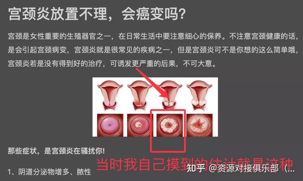 2、一同完房下面就癢是咋回事:每次同了房以後就會很癢怎麼回事