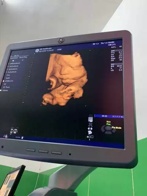 懷孕四個月男女分辨圖：請各位媽媽來驗證一下,當初B超看男女準確嗎?