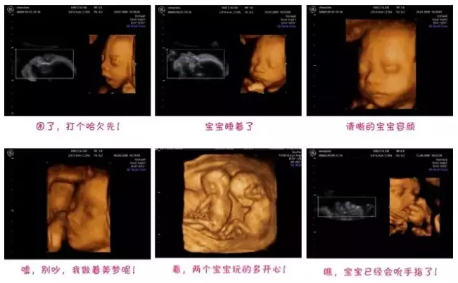 孕12周胎兒小雞彩超圖：十四周了做彩超看不到小雞是男孩是女孩