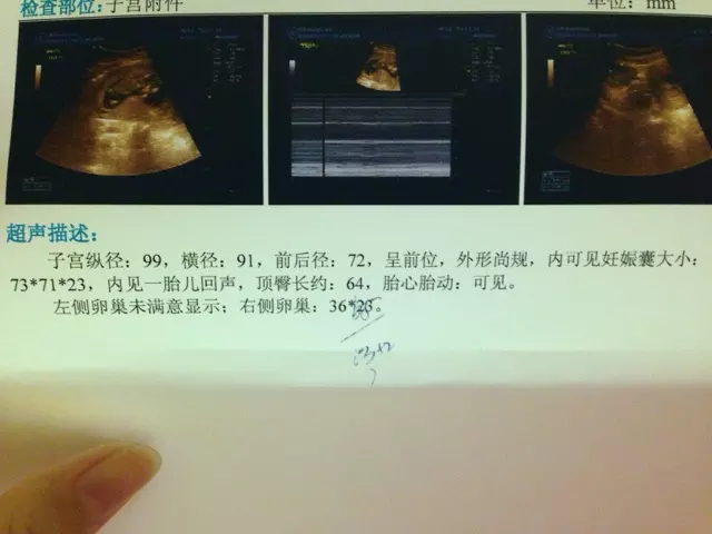 孕囊的三個數據看男女准嗎：胎囊3個數據看男女公式哪裡可以找到？