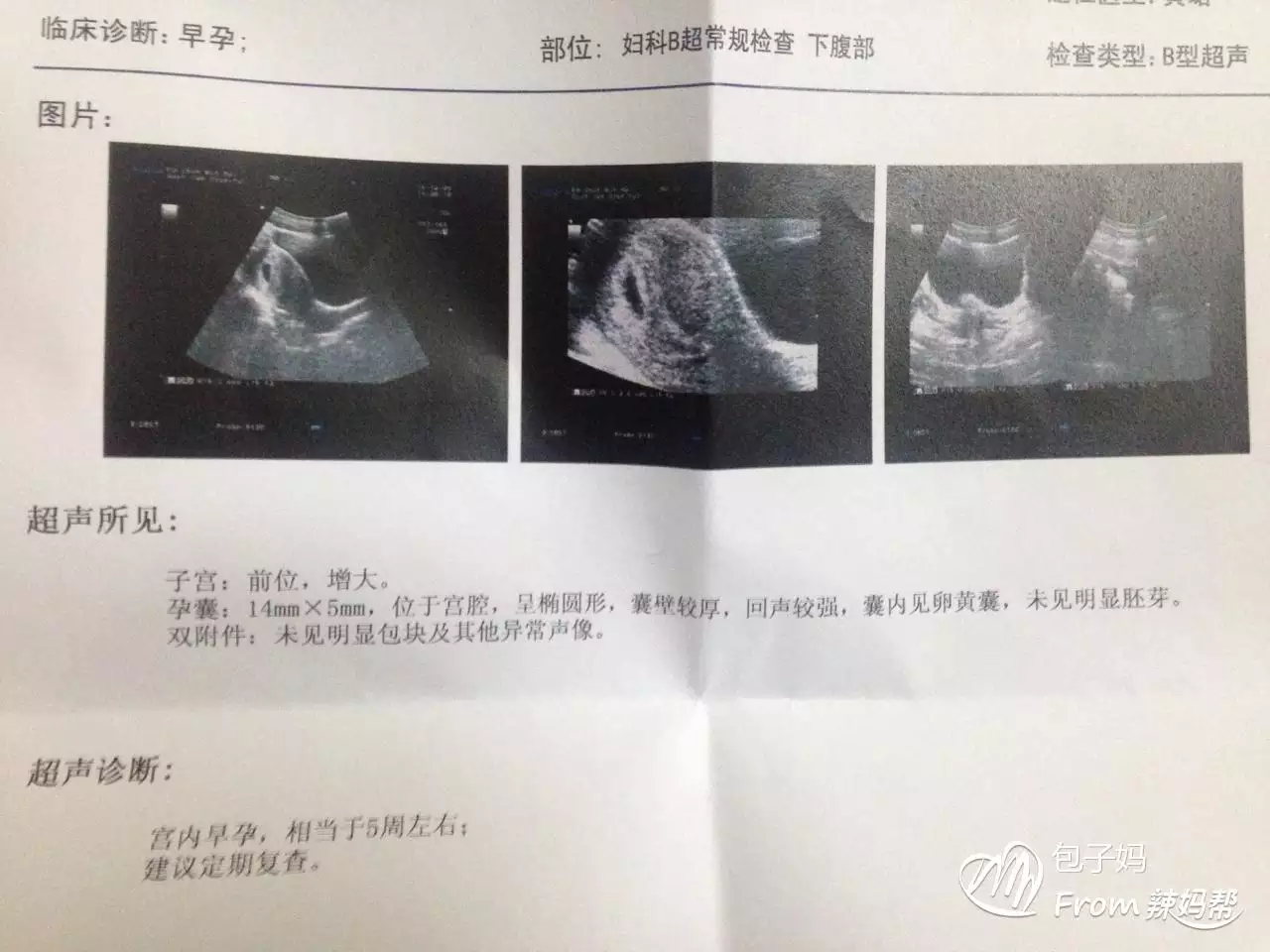 孕囊大小計算懷孕天數準確嗎：根據孕囊大小幫忙推算下天數，謝謝。