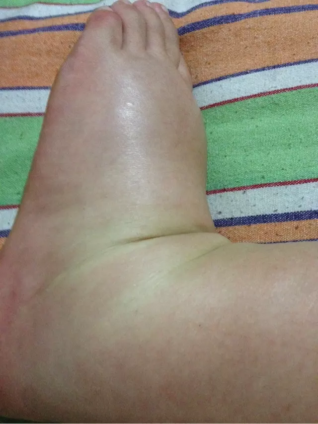 最後一個月腳腫看男女：馬上就要到預產期了，腳腫，不知道男孩女孩