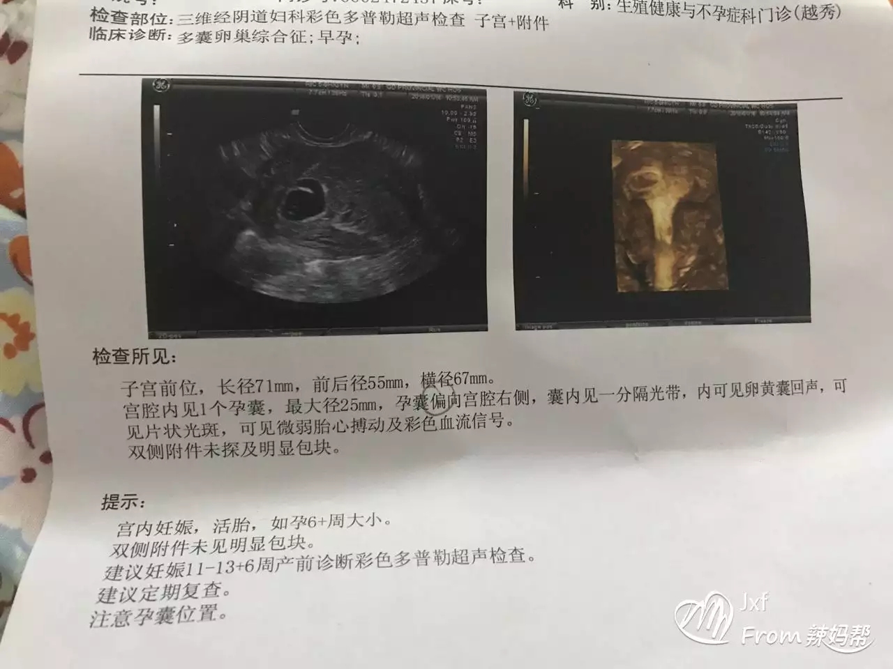孕囊多久可以能檢測出來：孕囊是圓形會生女孩嗎