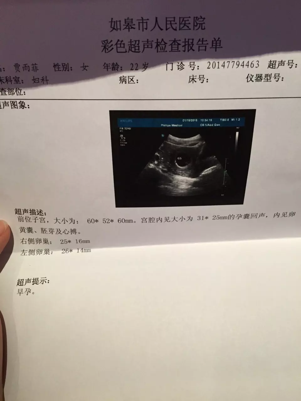 懷孕懷兒子有什麼癥狀：懷男孩的癥狀有哪些