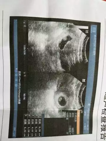 nt1.8mm是男孩還是女孩：nt值多少是男孩