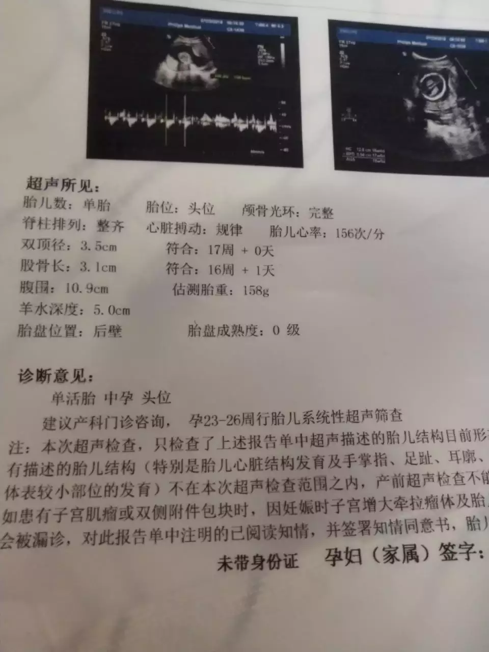 3、雙頂徑和股骨長判斷生男生女:雙頂徑的寶寶男孩還是女孩