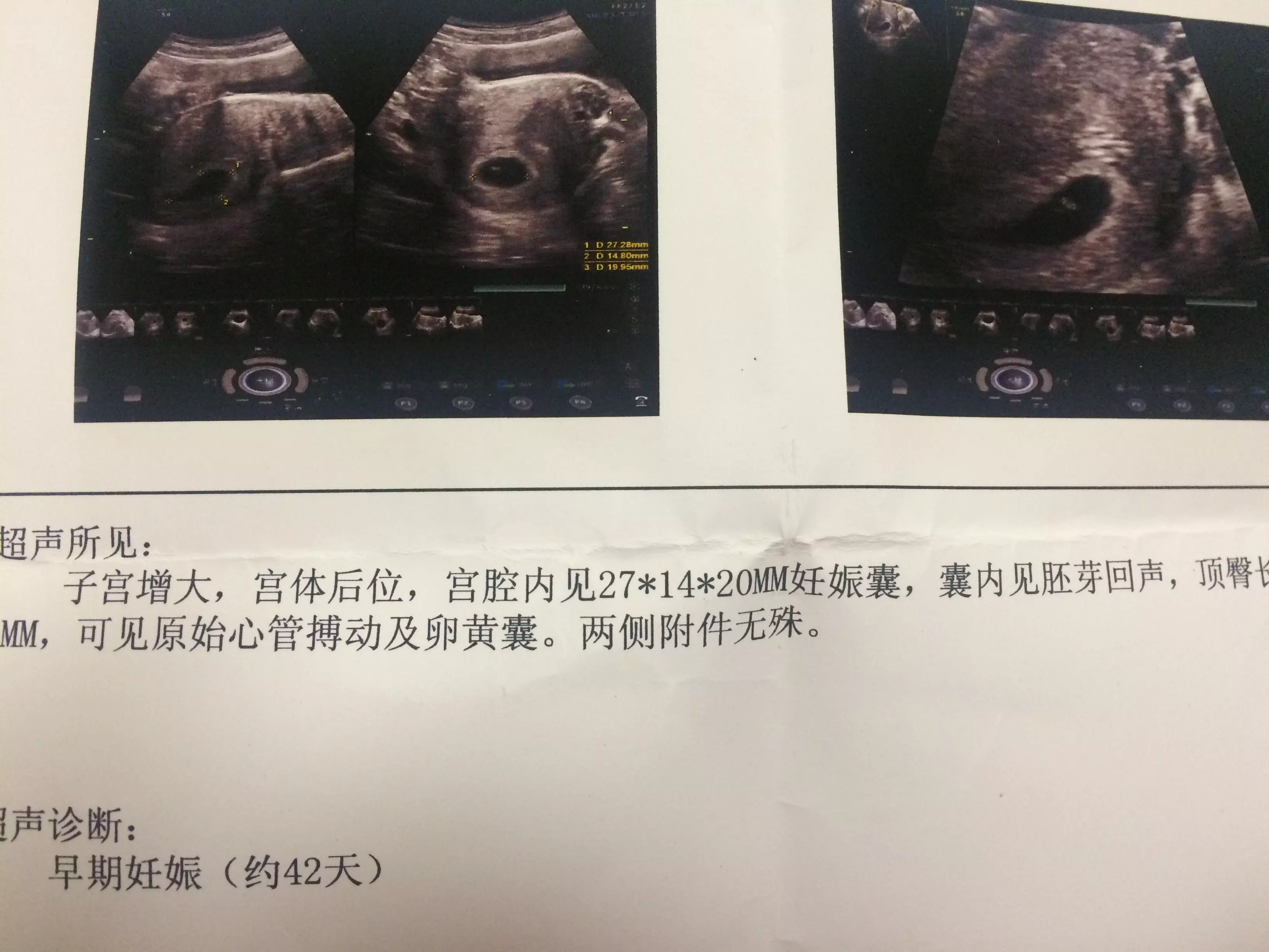 2、平躺下看男女,很准喲:看生男女最準確方法