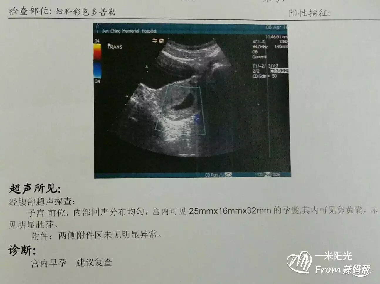 胎囊3個數據看男女公式：准媽媽生女兒的表現