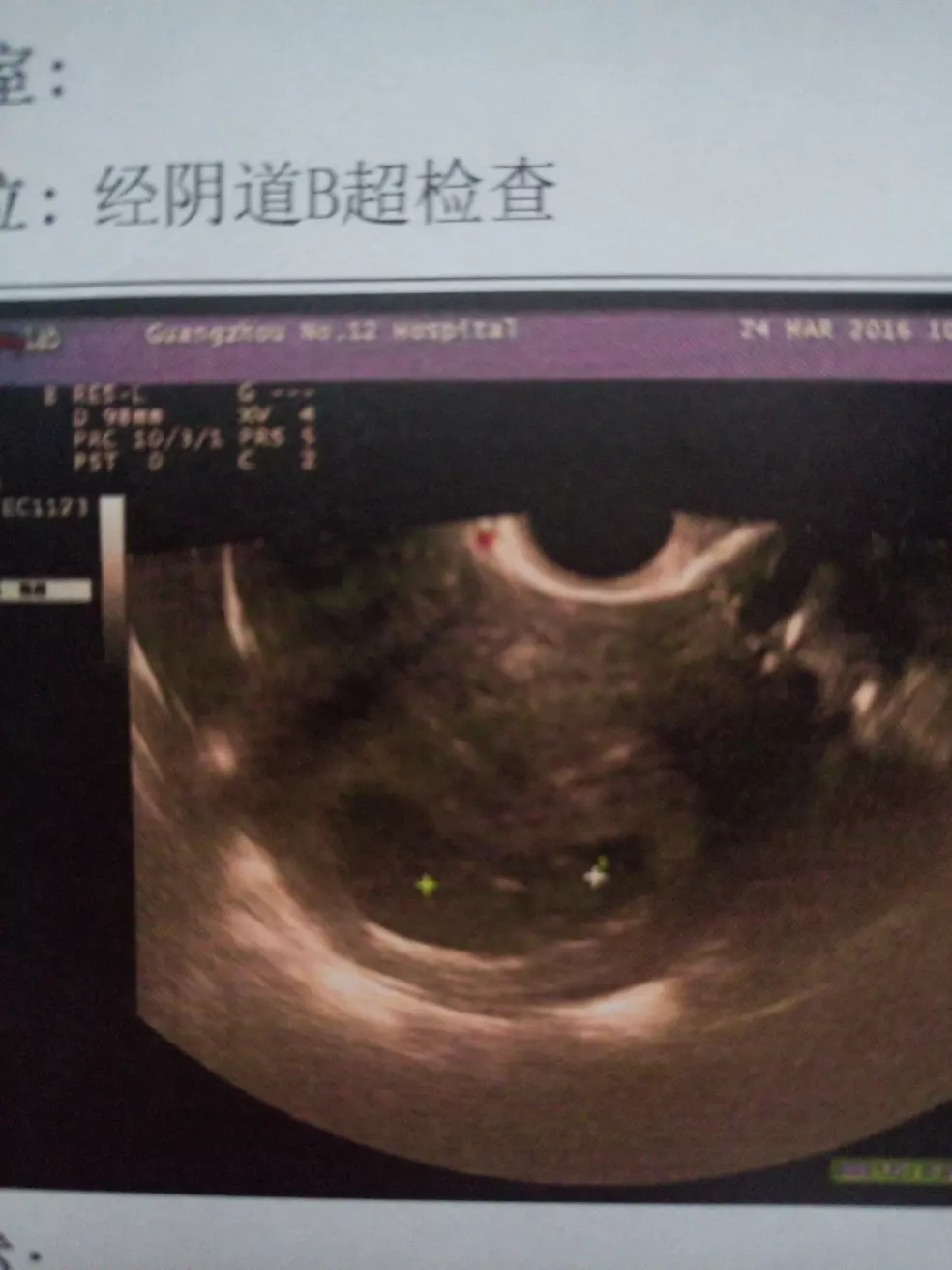 孕囊數據兩大一小是男孩：懷男孩會有哪些反應，胎動早的會是男孩嗎？