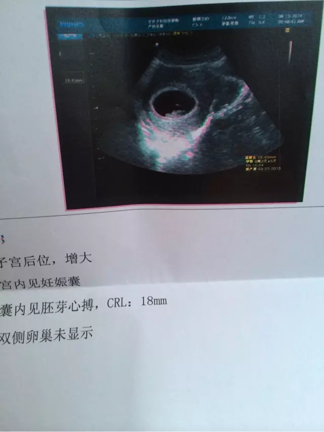 懷孕四個月怎麼看男女準確率高：四個月看男女的準確率