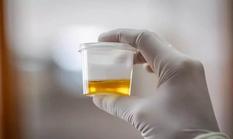 早上晨尿什麼顏色是正常的：正常人早晨起來尿應該是什麼顏色