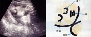懷孕b超單子怎麼看數據：孕檢的B超單上應該都有哪些數據？