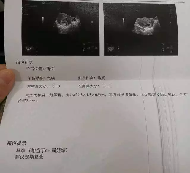 九個最准懷女孩徵兆胎囊：怎麼判斷懷的是男孩還是女孩最准