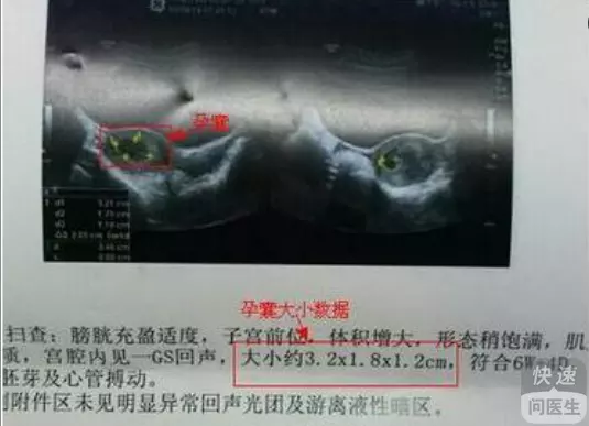 2、孕囊尺寸三個數據圖解看男孩:孕囊大小看性別哪三個數據