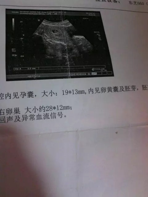 1、孕囊尺寸三個數據圖解看男孩:胎囊3個數據看男女公式哪裡可以找到？