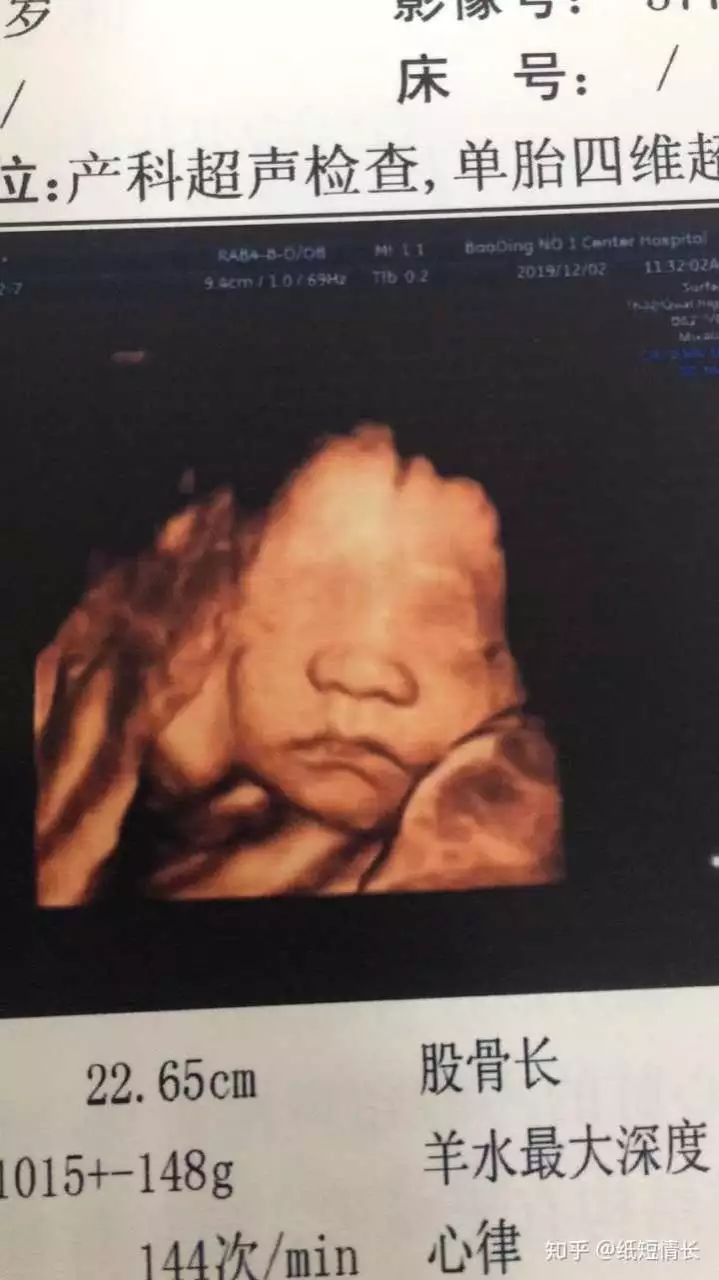 3、生兒子的四維彩超圖片:生孩子作文↘