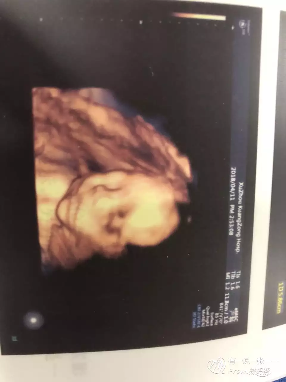 3、B超四維一看就是男孩:四維歸來,驗證胎寶是男孩!附完整詳細的寶癥狀!