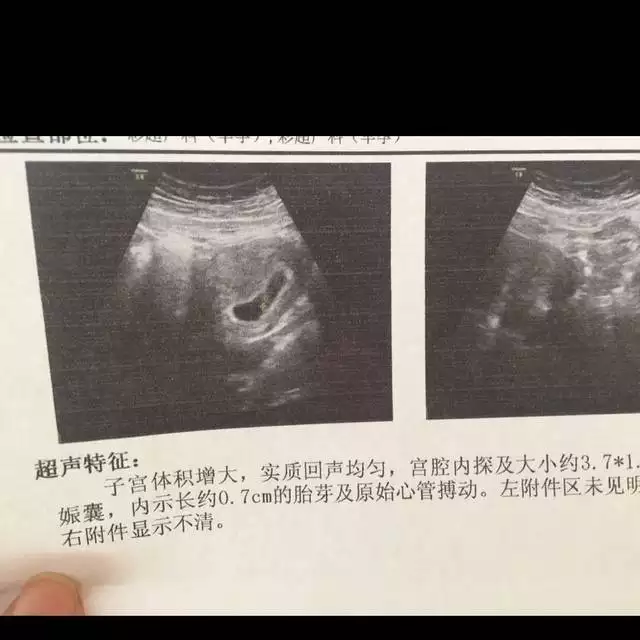 孕囊看男女到底準不準：看早期孕囊形狀看男女准嗎?