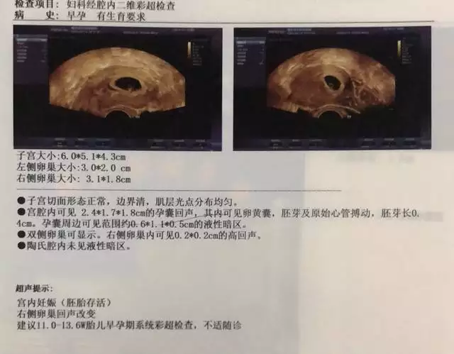5周孕囊圖片：懷孕40多天葯流的孕囊有多大