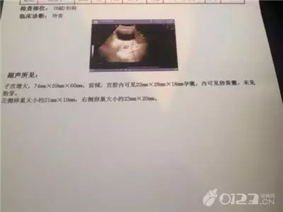 懷孕b超單子怎麼看數據：B超單怎麼看
