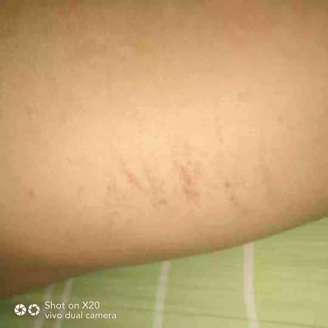2、哪種抓痕屬於出軌:同夥們看看是出軌的抓痕嗎謝謝