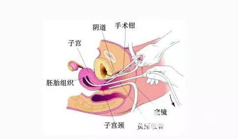 懷孕12周可以做無痛人流嗎：懷孕3個月做人流需要住院嗎？